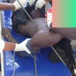 Cameroun – Hôpital Laquintinie de Douala : Les prouesse d&rsquo;une chirurgie sur un cas de traumatologie extrême.