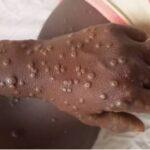 Cameroun – Alerte Sanitaire : Un cas de Mpox enregistré à Buea.
