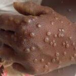 Cameroun – Kousseri : Cinq cas de Mpox identifiés.